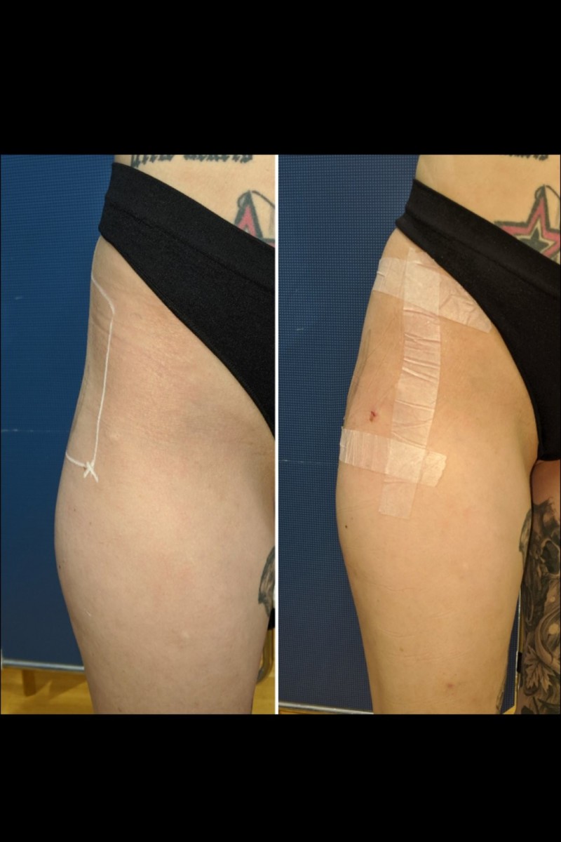 Lifted Rounder Butt, Hourglass shape, Removing hip dips