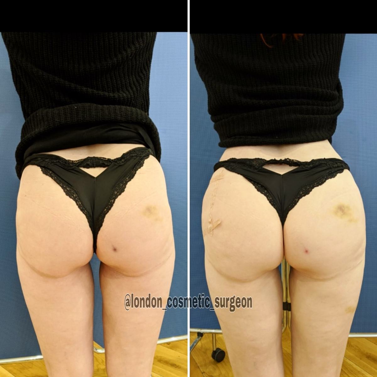 Hip Dip Filler: Non-Surgical Butt Lift