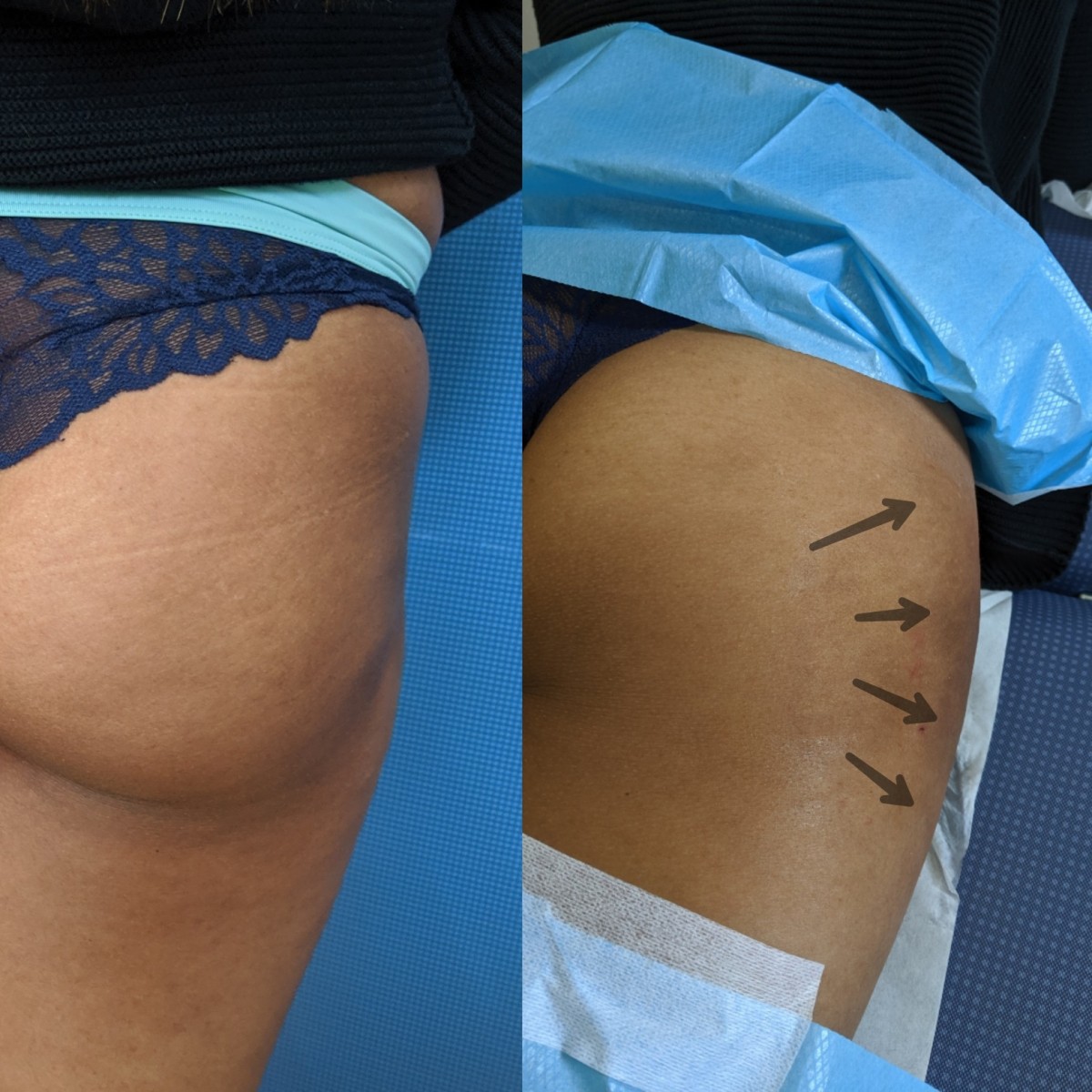 Enhance Your Butt With a Non Surgical Butt Lift