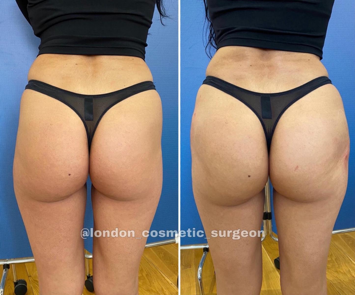 Women Skin-friendly Rear Holes Buttock Enhancer