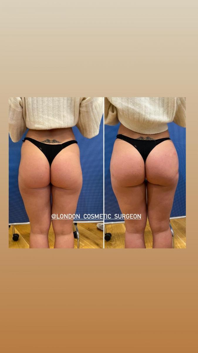 Buttock Augmentation Requires Lateral Hip Filling
