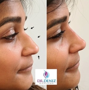 non surgical nose job after effects